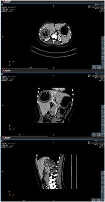 The Application of Preoperative Three-Dimensional Reconstruction Visualization Digital Technology in the Surgical Treatment of Hepatic Echinococcosis in Tibet